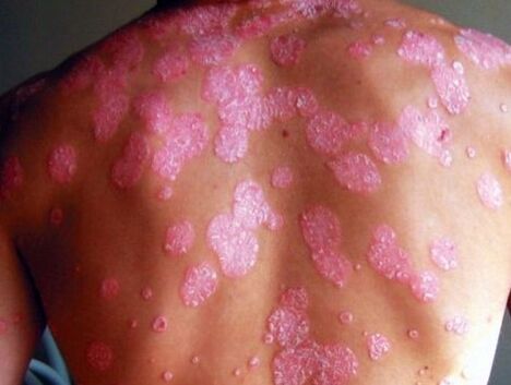Psoriatic disease
