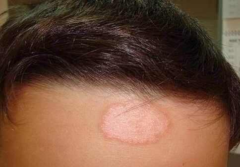 Psoriatic place